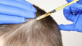 Mezoterapi Nedir | Selülit, Saç ve Yüz Mezoterapisi Faydaları Nelerdir Nasıl Yapılır?