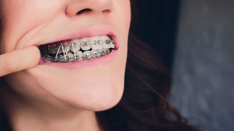Diş Teli Fiyatları 2020: Gülüşünüze Güzellik Katın | Dişlerinizin görünümünden rahatsız mısınız? Keşke daha düzgün dişlerim olsa mı diyorsunuz? İşte, diş teli hakkında her şey!