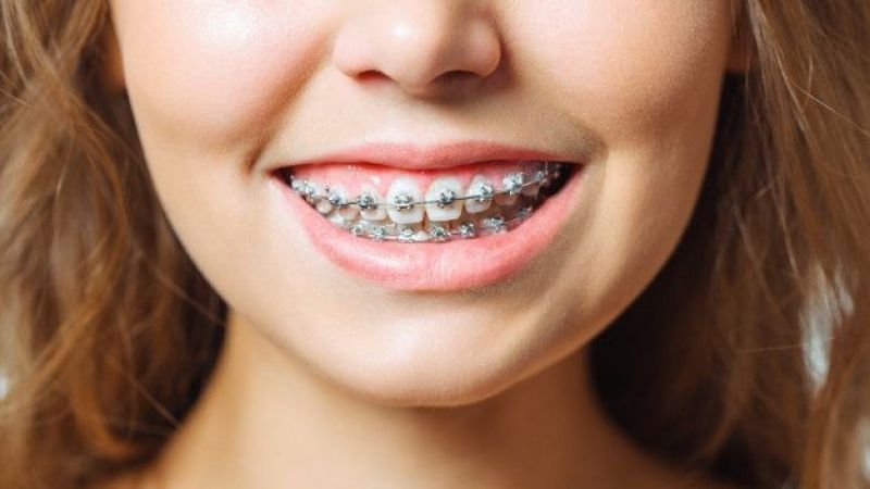 Diş Teli Fiyatları 2020: Gülüşünüze Güzellik Katın | Dişlerinizin görünümünden rahatsız mısınız? Keşke daha düzgün dişlerim olsa mı diyorsunuz? İşte, diş teli hakkında her şey!