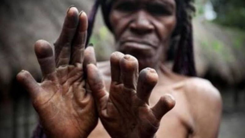 Papua Yeni Gine’de Yaşıyor Olsaydınız, Sevdiğiniz Biri Ölünce Parmağınızı Kesebilirdiniz