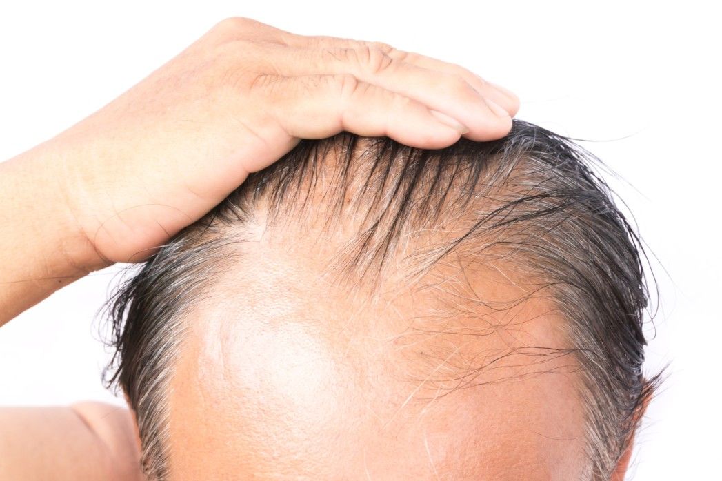 Erkeklerde Saç Dökülmesine Çözüm Var mı?