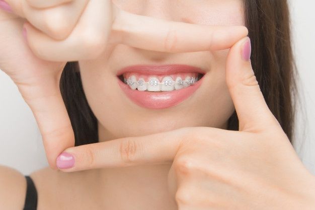 Diş Teli Fiyatları 2020: Gülüşünüze Güzellik Katın