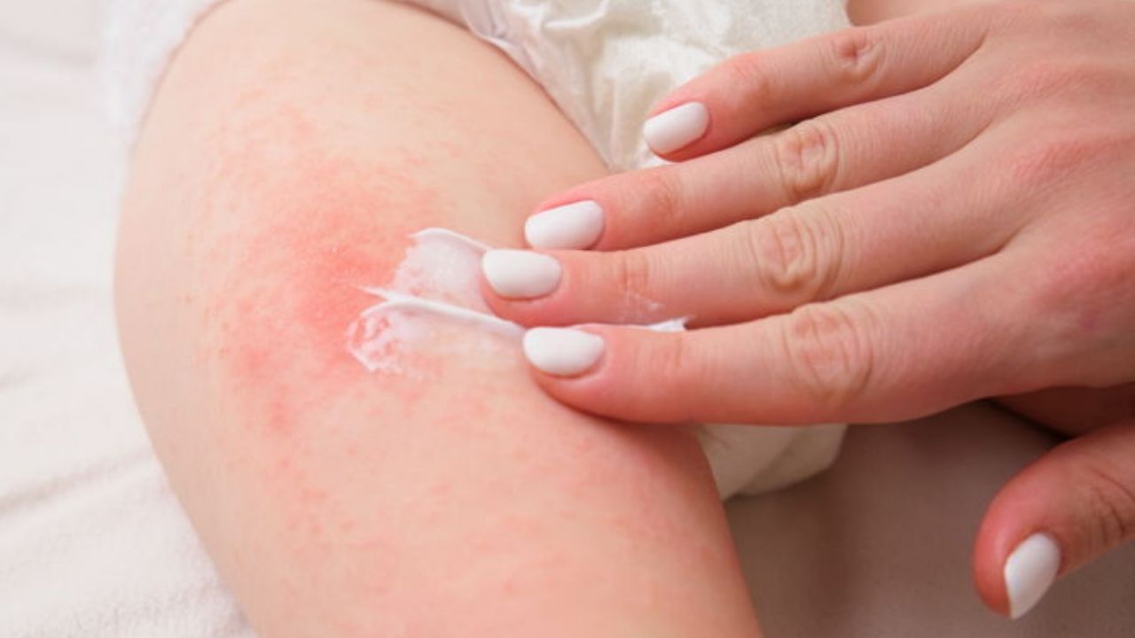 urederm-krem-nasil-kullanilir