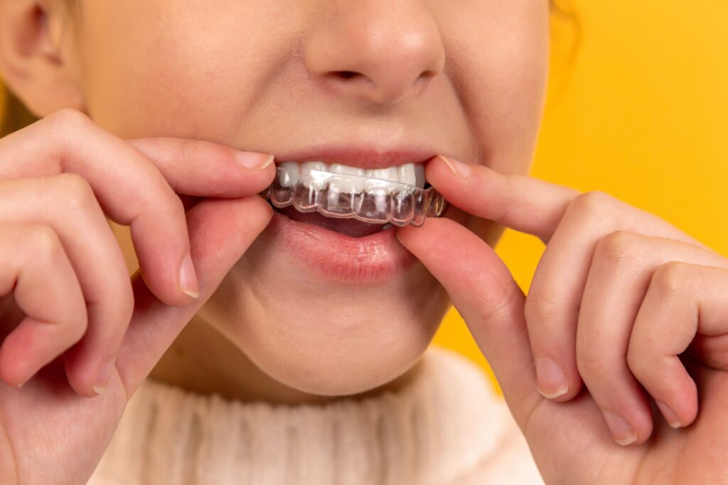 Şeffaf Diş Teli Nedir? Görünmeyen Şeffaf Diş Teli Pahalı Mı?