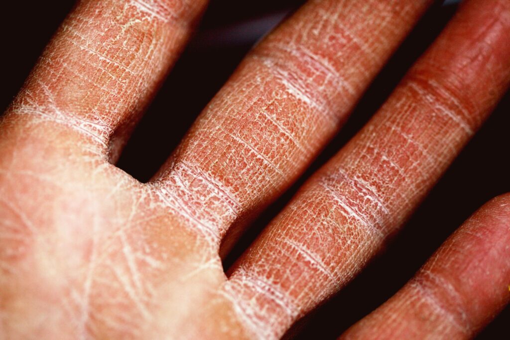 Seboreik Dermatit Ne İyi Gelir | Seboreik Dermatit Nasıl Kurtulurum?