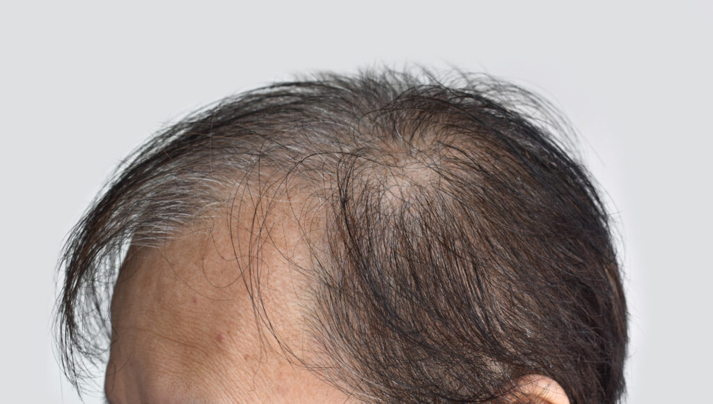 8000-grafts-hair-transplant