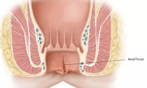Locafen Krem Ne İşe Yarar | Locafen Krem Ne Kadar Sürede Etki Eder?
