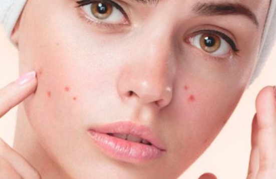 Sivex Losyon Sivilce İzlerini Geçirir mi? Sivex Losyon Ne İşe Yarar?