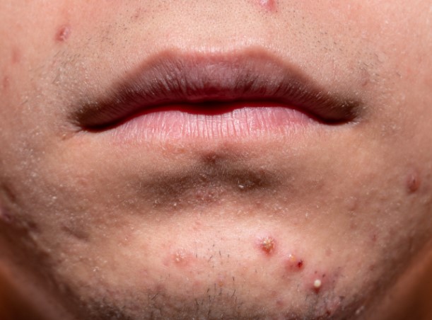 Sivex Losyon Sivilce İzlerini Geçirir mi? Sivex Losyon Ne İşe Yarar?