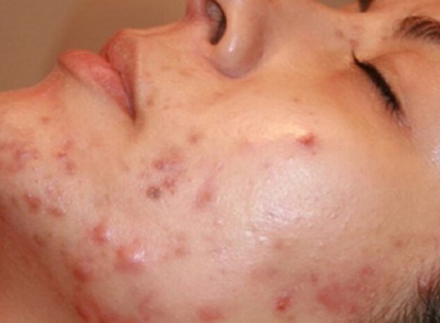 Sivex Losyon Sivilce İzlerini Geçirir mi? Sivex Losyon Ne İşe Yarar?