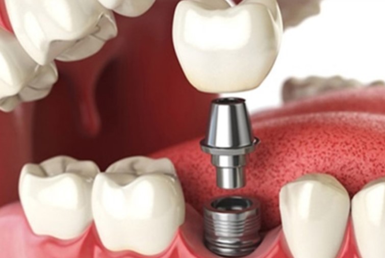 İmplant Yaptırdım Pişmanım Dememek İçin 7 Noktaya Dikkat Edin