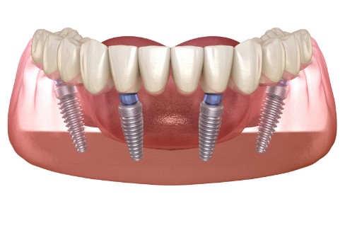 İmplant Yaptırdım Pişmanım Dememek İçin 7 Noktaya Dikkat Edin