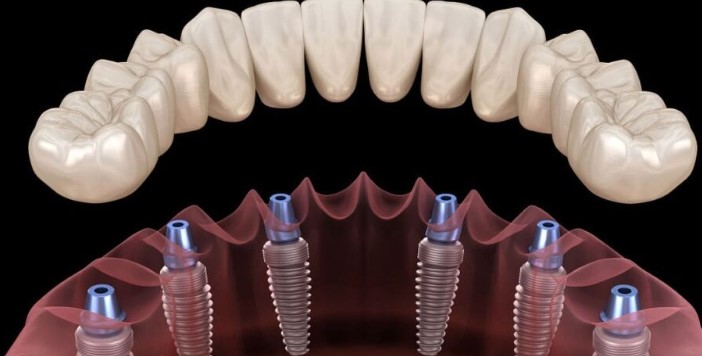 İmplant Yaptırdım Pişmanım Dememek İçin 7 Noktaya Dikkat Edin