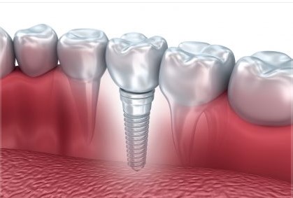 İmplant Yaptırdım Pişmanım Dememek İçin 7 Noktaya Dikkat Edin