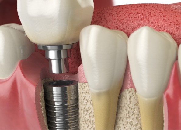 İmplant Yaptırdım Pişmanım Dememek İçin 7 Noktaya Dikkat Edin