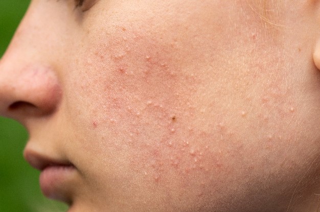 Komedon Nedir | Komedon Nasıl Geçer? Komedona Ne İyi Gelir? 