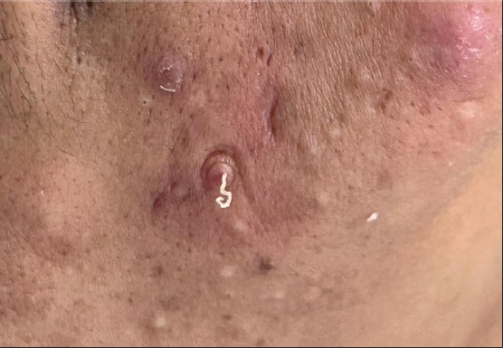 Komedon Nedir | Komedon Nasıl Geçer? Komedona Ne İyi Gelir?