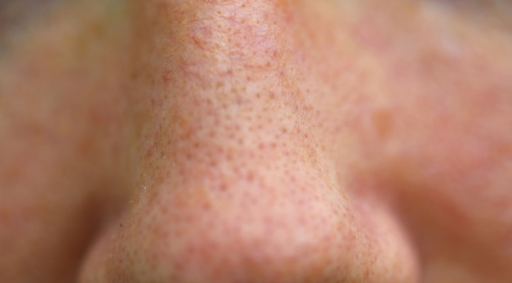 Komedon Nedir | Komedon Nasıl Geçer? Komedona Ne İyi Gelir?