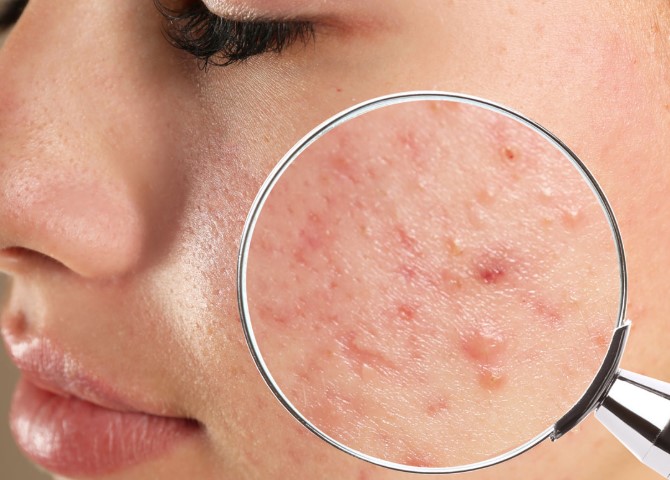 Komedon Nedir | Komedon Nasıl Geçer? Komedona Ne İyi Gelir?