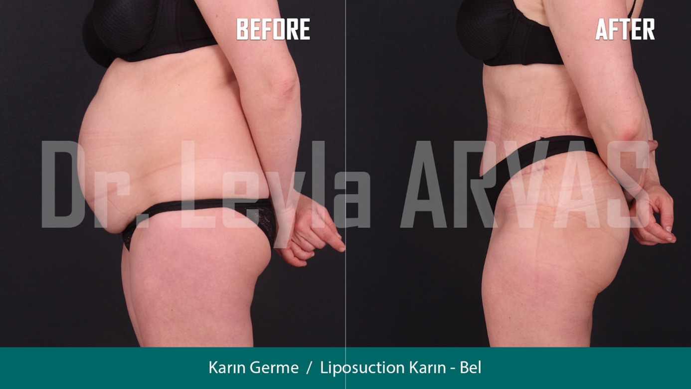 Karın Germe Ameliyatı: Estetik ve Sağlıklı Bir Karın Görünümü
