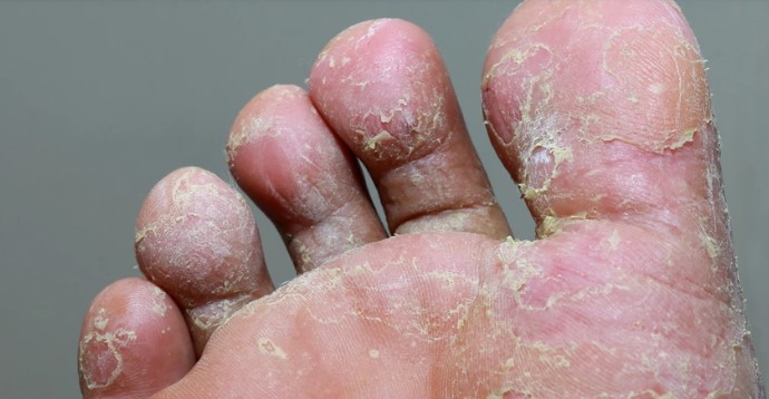 Dermifin Krem Ne İşe Yarar | Dermifin Nedir ve Ne İşe Yarar? Dermifin Fiyat Bilgisi Nedir?