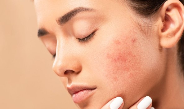 Acnemix Jel Ne İşe Yarar | Acnemix Nasıl Kullanılır? Acnemix Yan Etkileri Nelerdir?