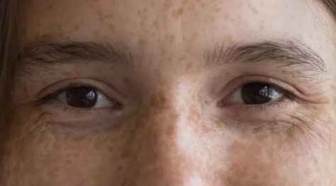 Güneş Lekesi Geçer mi? Güneş Lekesi Kendiliğinden Geçer mi?