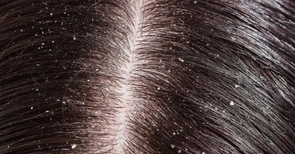 Saçta Kepek Nasıl Giderilir | En Kısa Sürede Saç Kepeğini Giderecek Öneriler 