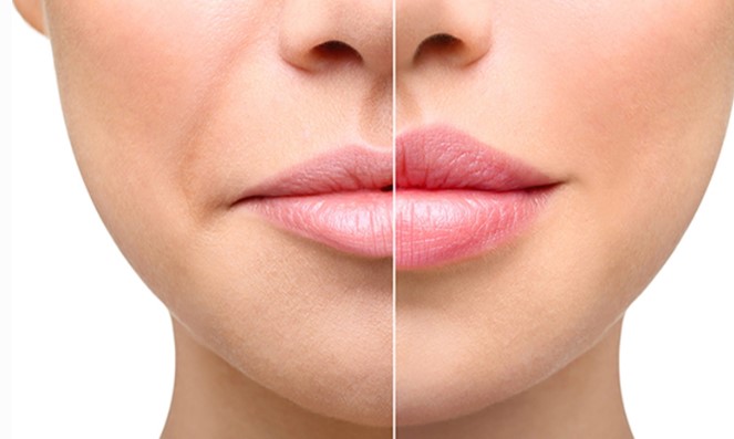 Dudak Dolgusu Sonrası Nelere Dikkat Edilmeli | Dudak Dolgusu Sonrası Şişlik Normal mi?