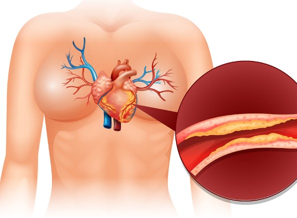 Kötü Kolesterol Nasıl Düşürülür | Kötü Kolesterolü Olanlar Ne Yemeli? 
