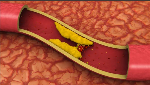 Kötü Kolesterol Nasıl Düşürülür | Kötü Kolesterolü Olanlar Ne Yemeli? 