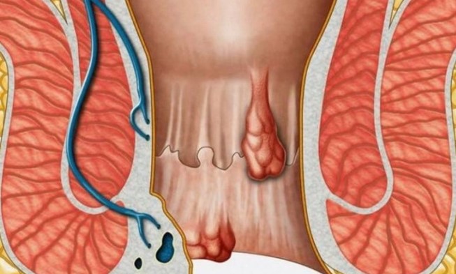 Rectoderm Krem Nedir Ne İşe Yarar | Rectoderm Krem Etken Maddesi Ne?