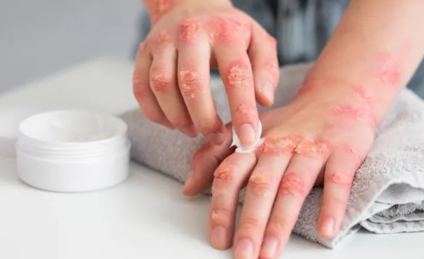 Travazol Krem Nedir | Travazol Kremin Yan Etkileri Nelerdir?