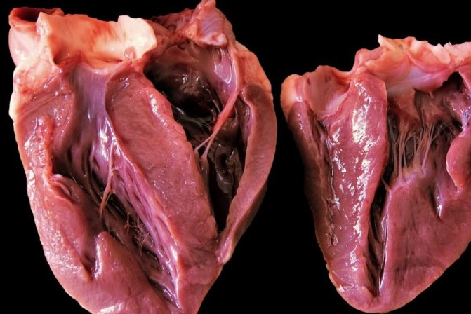 Kalp Kası Kalınlaşması Neden Olur | Kalp Kalınlaşması Tehlikeli midir?