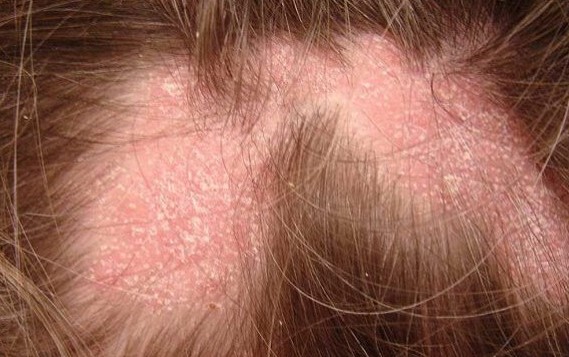 Saç Derisinde Yara ve Kabuklanma Neden Olur? Saç Dipleri Neden Yara Olur?