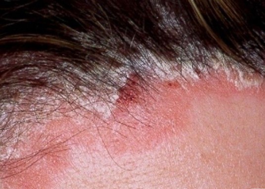 Saç Derisinde Yara ve Kabuklanma Neden Olur? Saç Dipleri Neden Yara Olur?