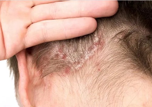 Saç Derisinde Yara ve Kabuklanma Neden Olur? Saç Dipleri Neden Yara Olur?