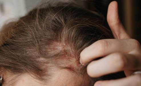 Saç Derisinde Yara ve Kabuklanma Neden Olur? Saç Dipleri Neden Yara Olur?