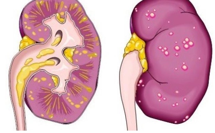 Böbrek İltihabı Belirtileri Nelerdir? Böbrek İltihabı Nasıl Geçer?
