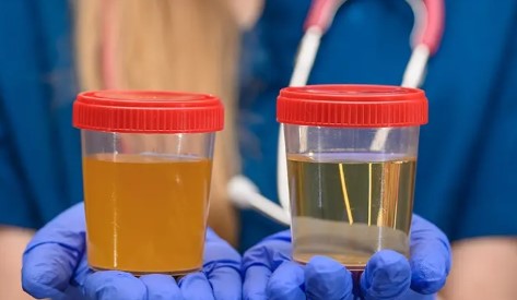 Böbrek İltihabı Belirtileri Nelerdir? Böbrek İltihabı Nasıl Geçer?