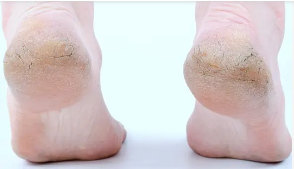 Topuk Çatlağı Nedir? Topuk Çatlaklarına Ne İyi Gelir?