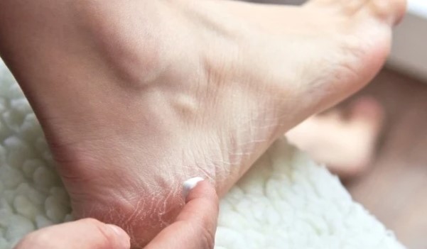 Topuk Çatlağı Nedir? Topuk Çatlaklarına Ne İyi Gelir?