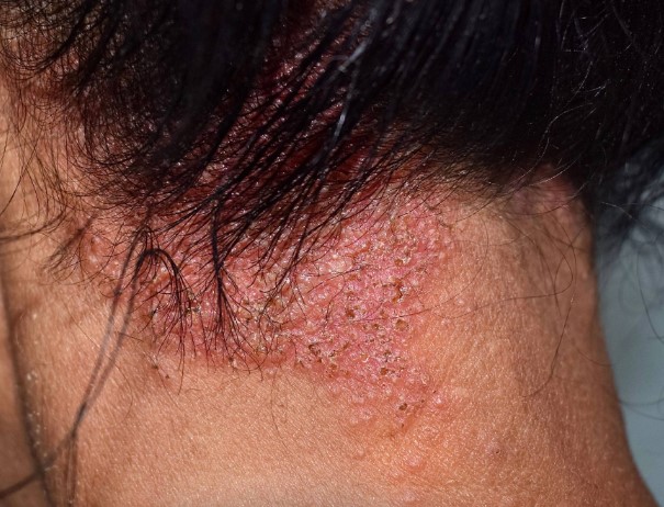 Exelderm Krem Ne İşe Yarar | Exelderm Krem Yüze Sürülür mü? Exelderm Krem Nasıl Kullanılır?