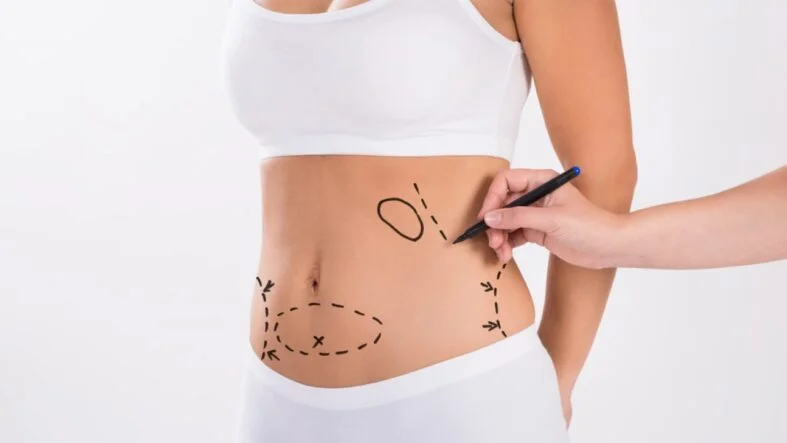 Liposuction ile Tüm İnatçı Yağlara Kısa Sürede Veda Edin