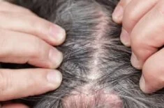 Saç Derisinde Yara ve Kabuklanma Neden Olur? Saç Dipleri Neden Yara Olur? 