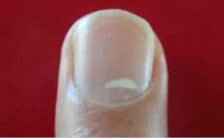 Tırnakta Beyaz Leke Neden Olur | Tırnakta Beyaz Leke Nasıl Geçer? 