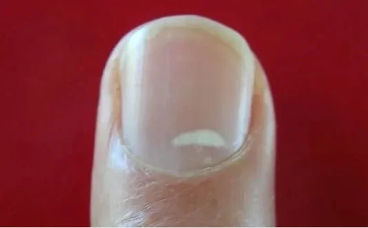 Tırnakta Beyaz Leke Neden Olur | Tırnakta Beyaz Leke Nasıl Geçer? 