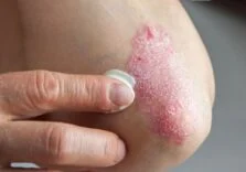 Elidel Krem Ne İşe Yarar | Elidel Krem Sürekli Kullanılır mı? Elidel Krem Nasıl Kullanılır? 