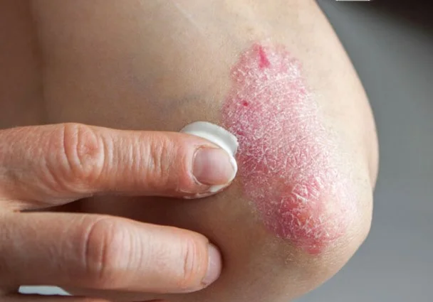 Elidel Krem Ne İşe Yarar | Elidel Krem Sürekli Kullanılır mı? Elidel Krem Nasıl Kullanılır? 