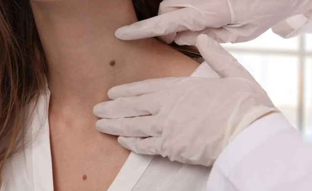 Kırmızı Benler Nasıl Geçer | Ciltteki Kırmızı Lekeler Nasıl Geçer? 